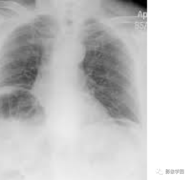 影像PPT - Chilaiditi 综合征(间位结肠综合征)-2 影像PPT - Chilaiditi 综合征(间位结肠综合征)-2
