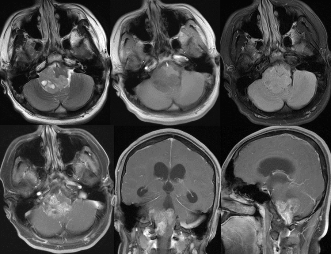 影像PPT - 室管膜肿瘤—放射医生应该知道的基因组学-29 影像PPT - 室管膜肿瘤—放射医生应该知道的基因组学-29