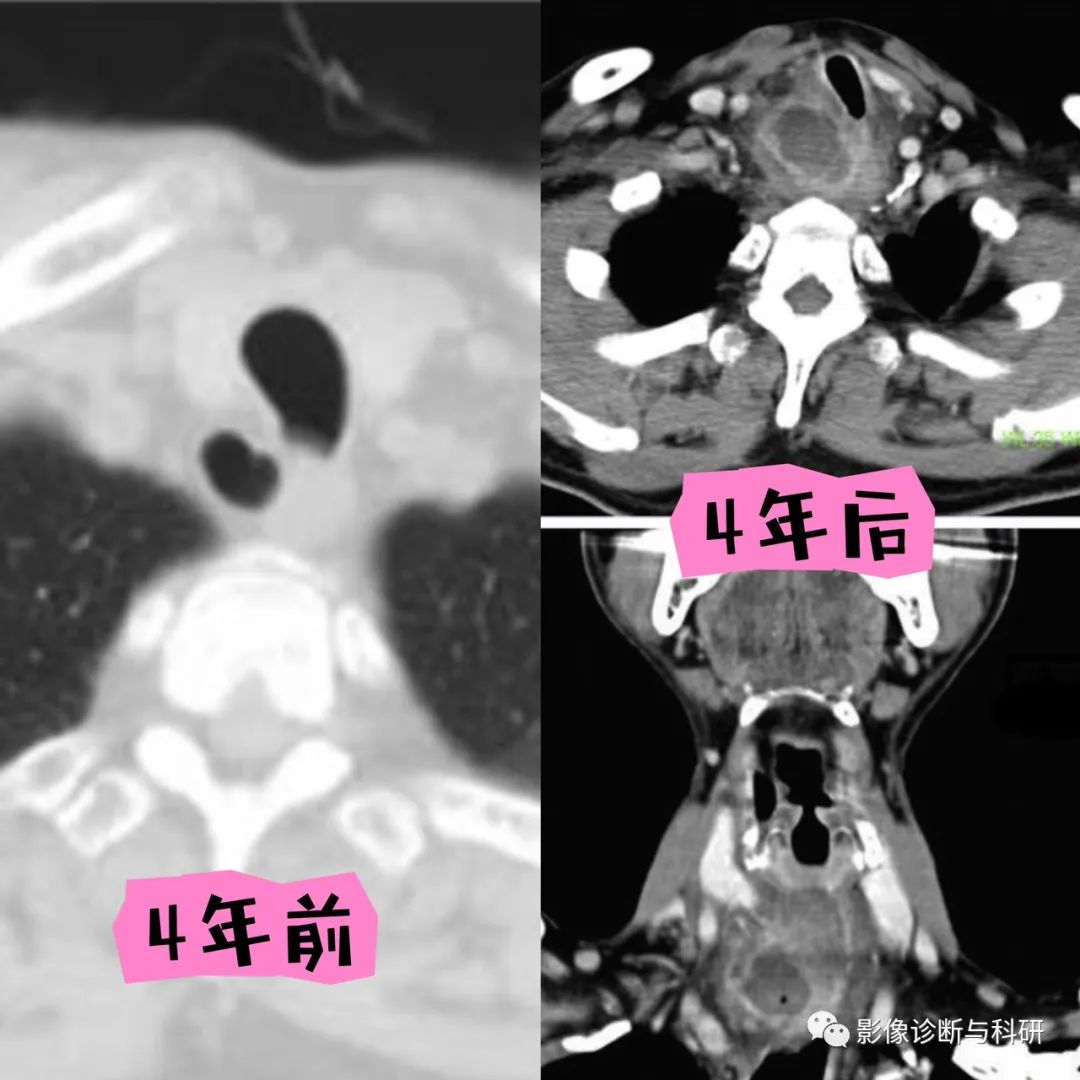 影像PPT - 气管憩室的影像诊断与鉴别诊断-5 影像PPT - 气管憩室的影像诊断与鉴别诊断-5