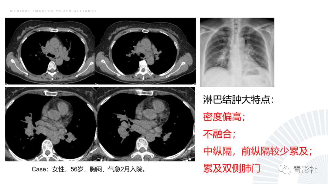 影像PPT - 【PPT】结节病的影像诊断思路-4