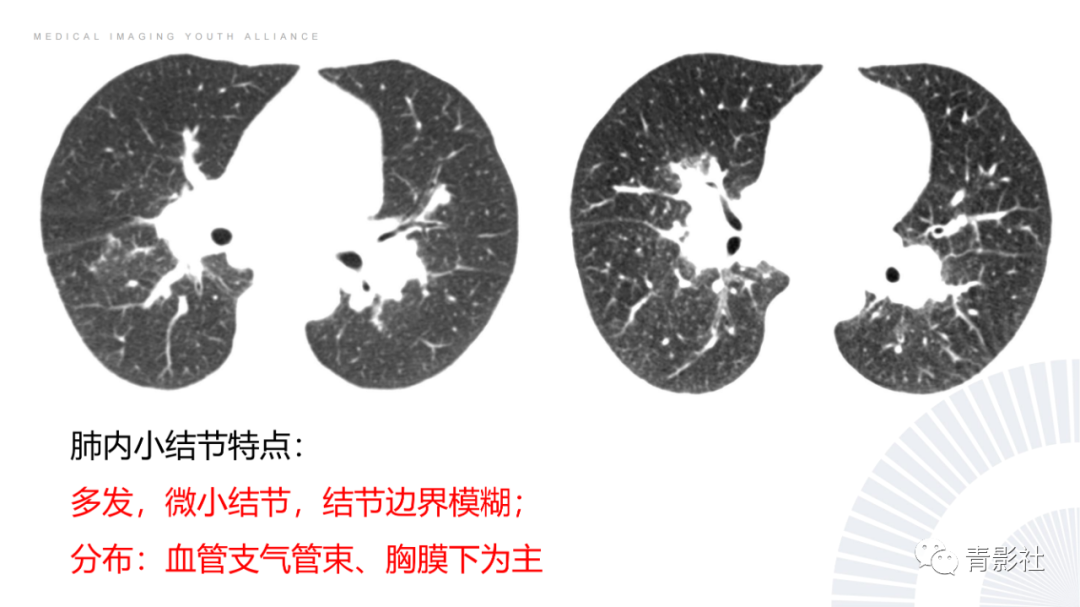 影像PPT - 【PPT】结节病的影像诊断思路-5