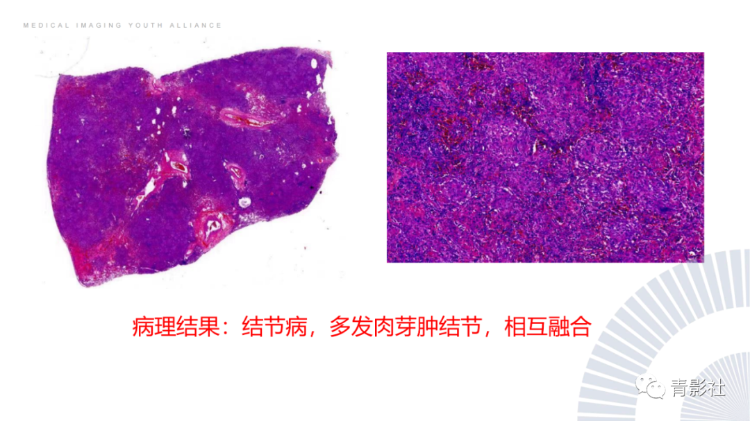 影像PPT - 【PPT】结节病的影像诊断思路-6