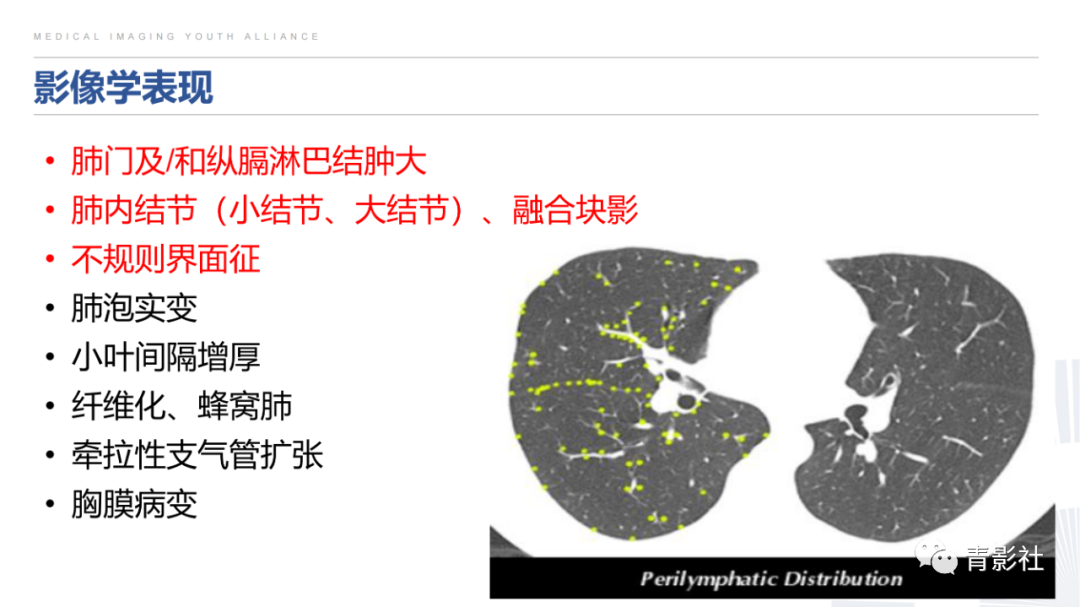 影像PPT - 【PPT】结节病的影像诊断思路-13