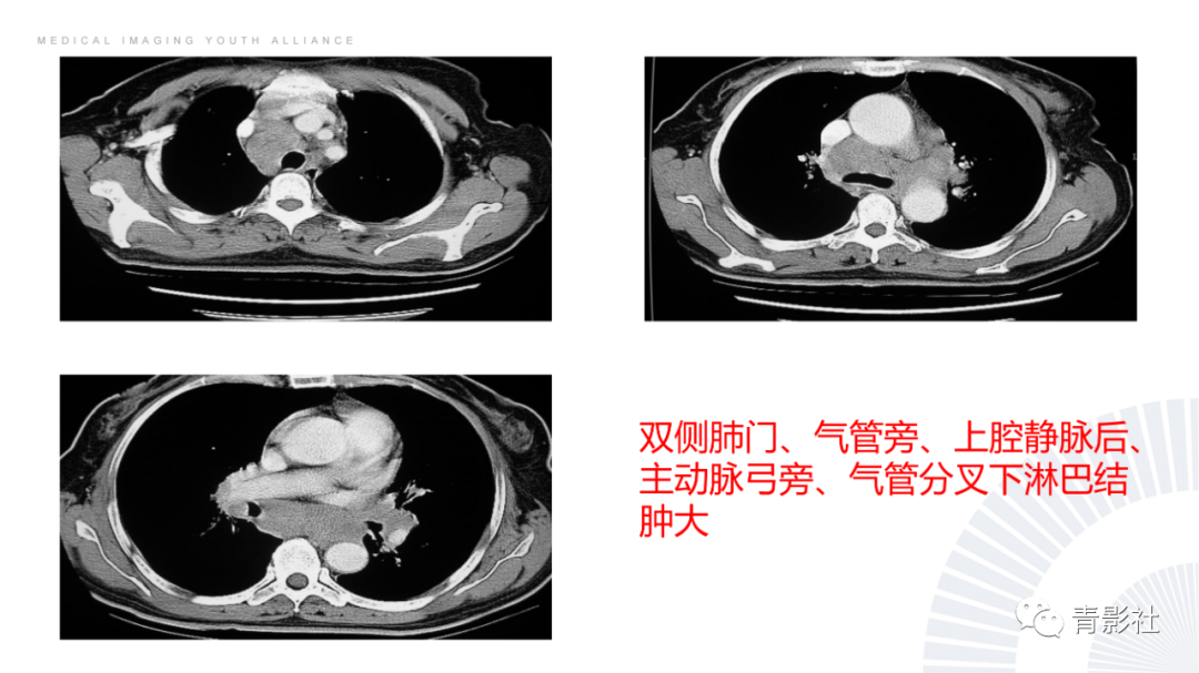 影像PPT - 【PPT】结节病的影像诊断思路-14
