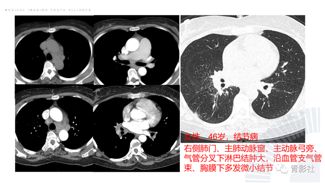 影像PPT - 【PPT】结节病的影像诊断思路-15