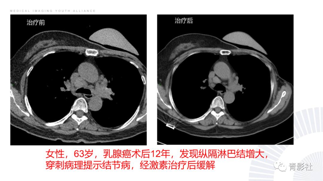 影像PPT - 【PPT】结节病的影像诊断思路-18