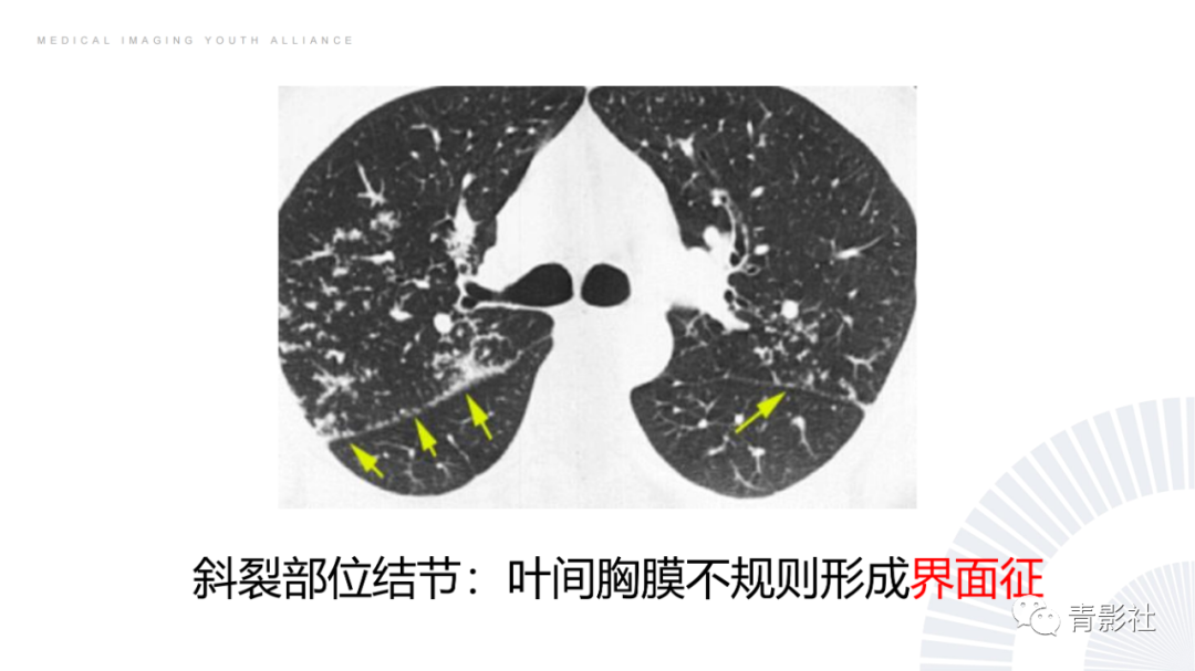 影像PPT - 【PPT】结节病的影像诊断思路-20