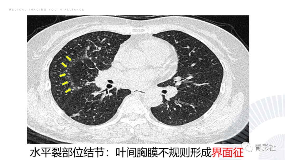 影像PPT - 【PPT】结节病的影像诊断思路-21