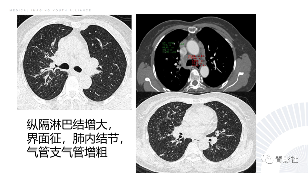 影像PPT - 【PPT】结节病的影像诊断思路-22