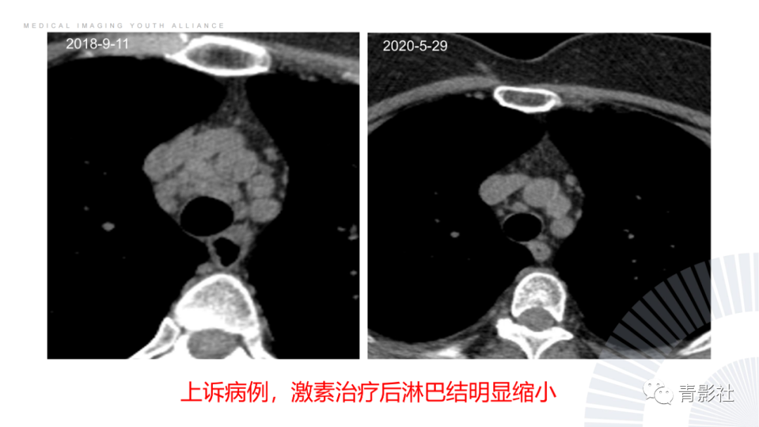 影像PPT - 【PPT】结节病的影像诊断思路-26