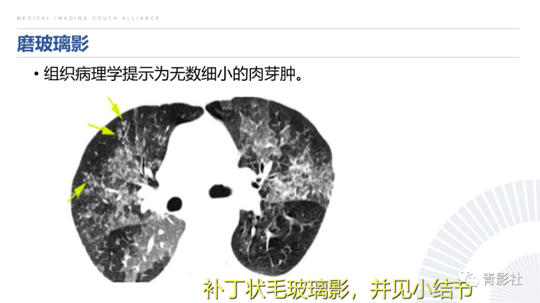 影像PPT - 【PPT】结节病的影像诊断思路-27