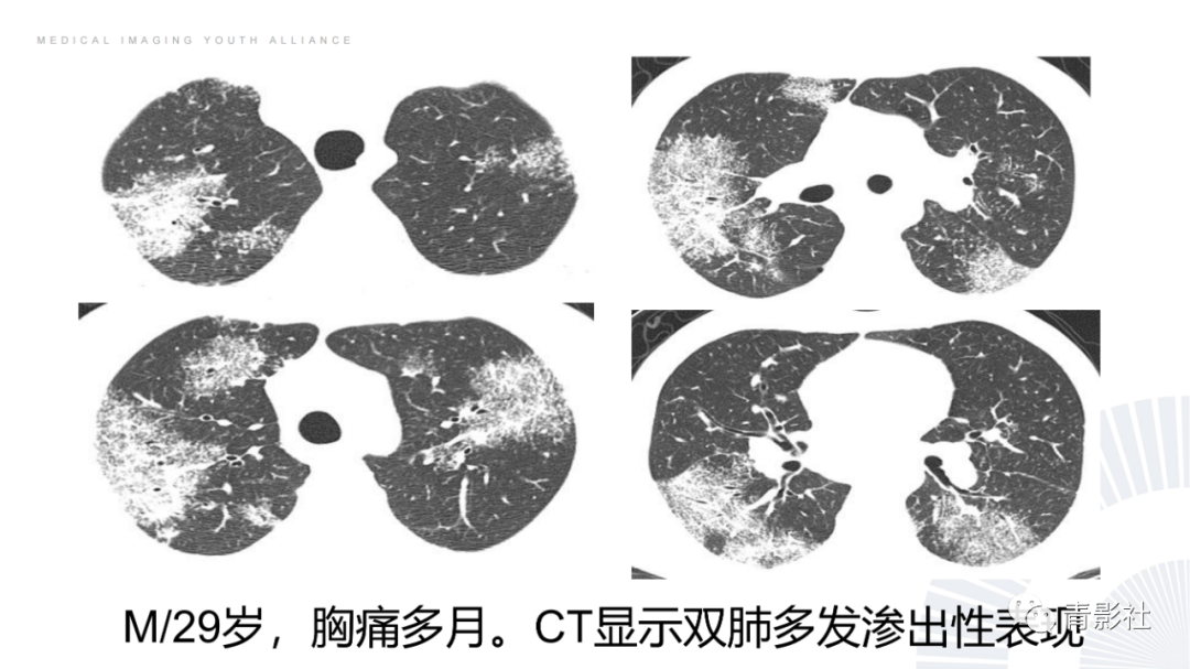 影像PPT - 【PPT】结节病的影像诊断思路-28