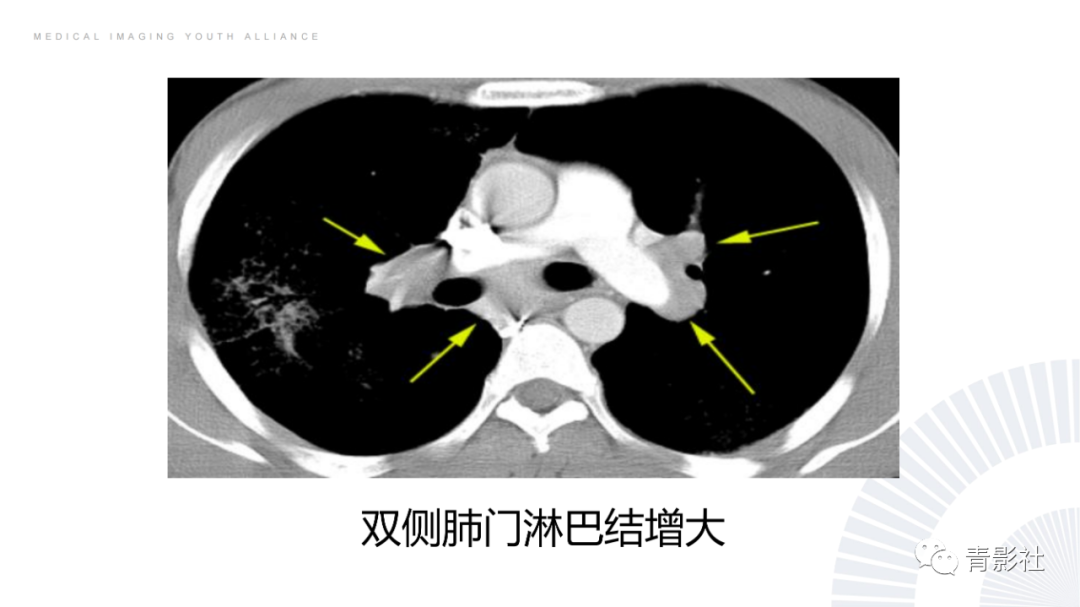 影像PPT - 【PPT】结节病的影像诊断思路-29