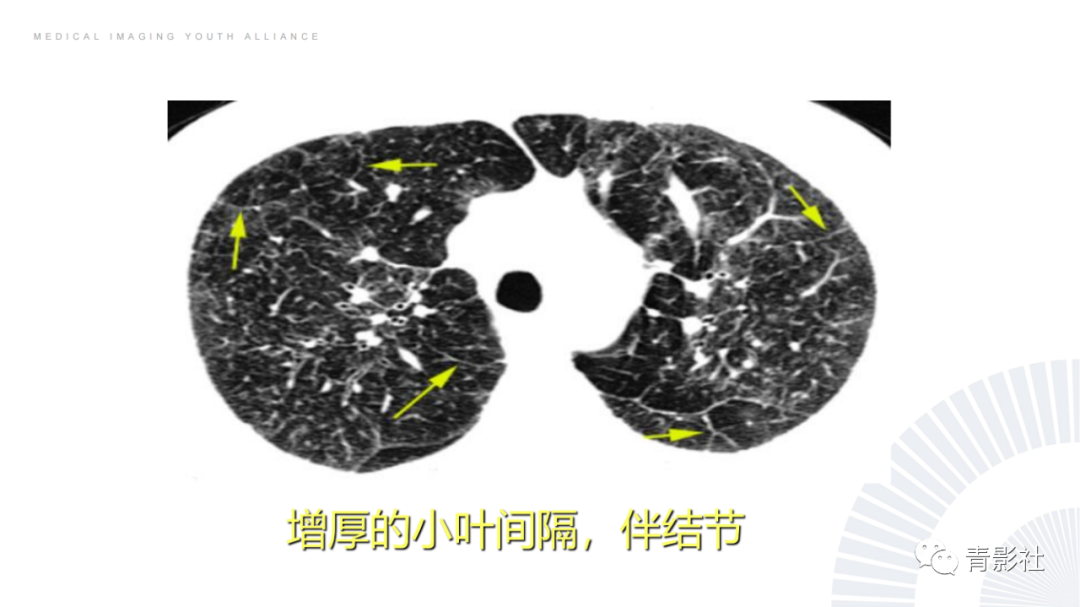 影像PPT - 【PPT】结节病的影像诊断思路-30