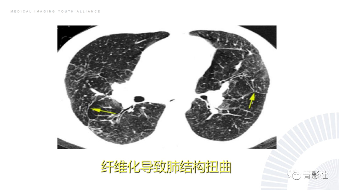 影像PPT - 【PPT】结节病的影像诊断思路-31