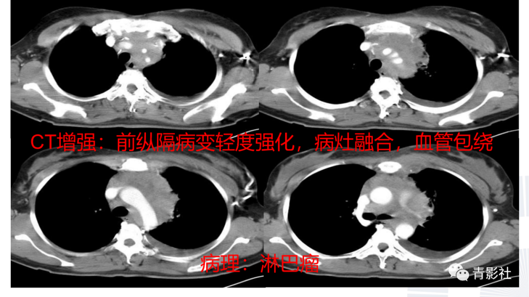 影像PPT - 【PPT】结节病的影像诊断思路-38