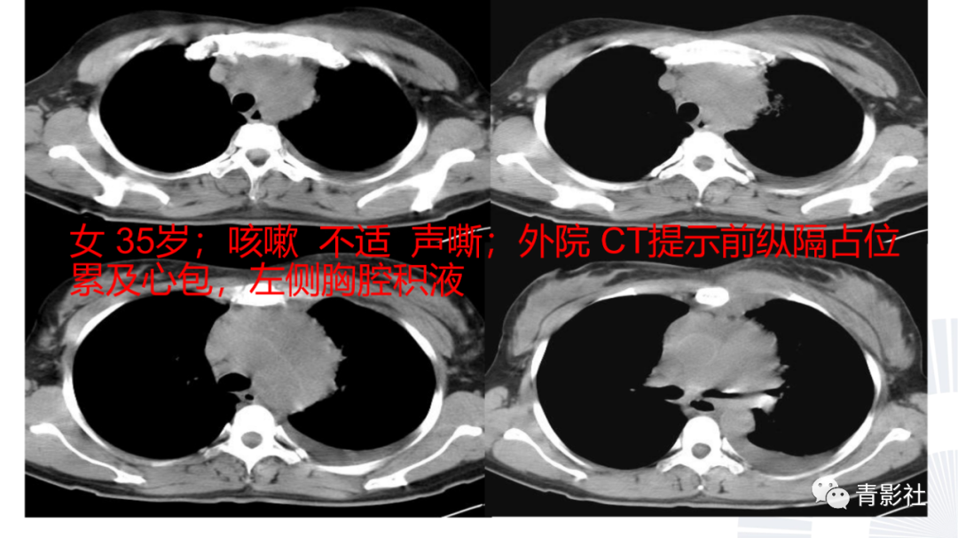 影像PPT - 【PPT】结节病的影像诊断思路-37