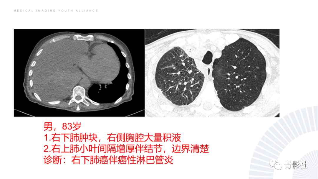 影像PPT - 【PPT】结节病的影像诊断思路-41