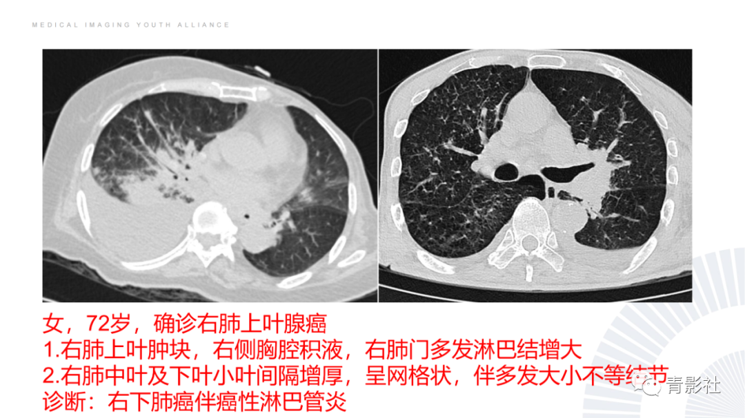 影像PPT - 【PPT】结节病的影像诊断思路-42