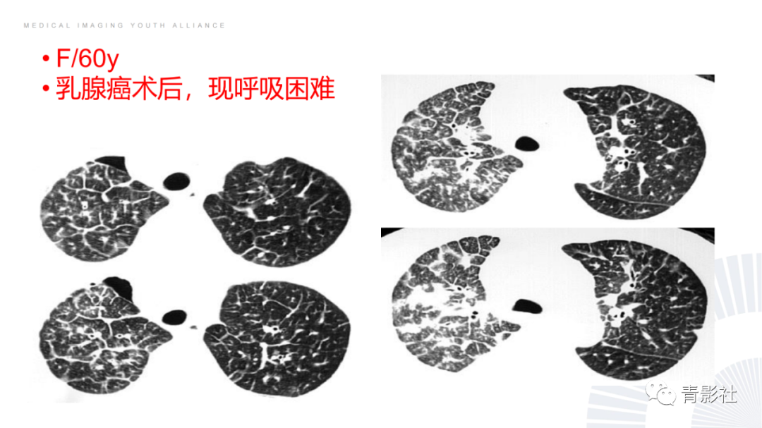 影像PPT - 【PPT】结节病的影像诊断思路-44