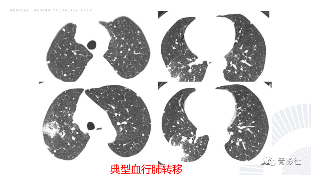 影像PPT - 【PPT】结节病的影像诊断思路-45