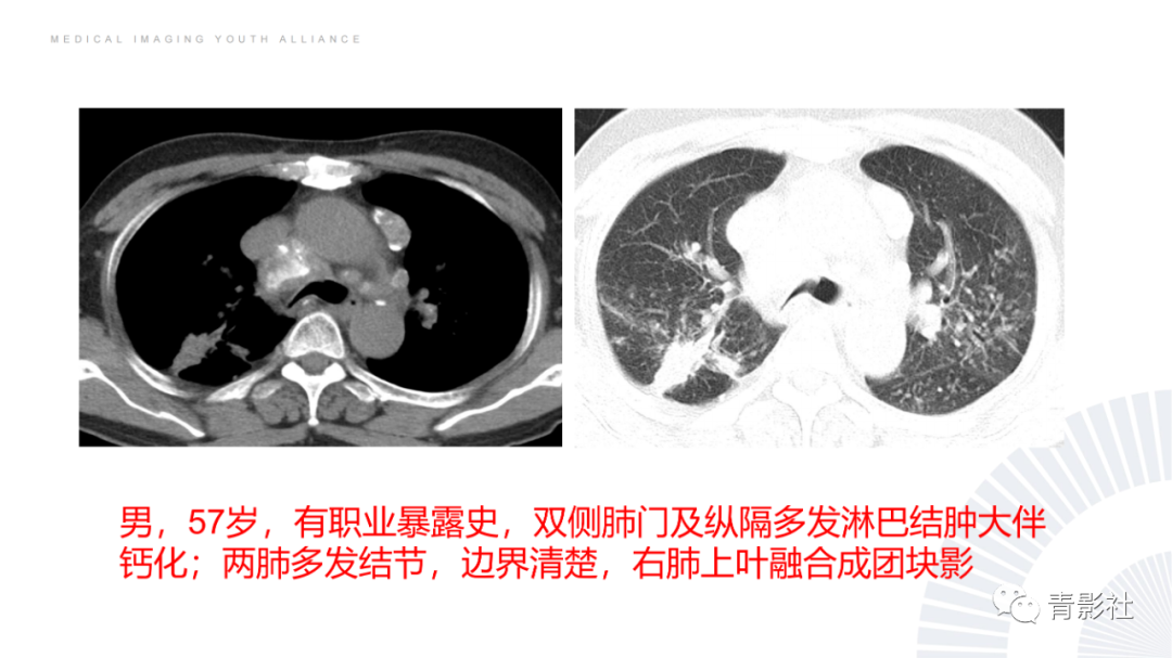 影像PPT - 【PPT】结节病的影像诊断思路-48