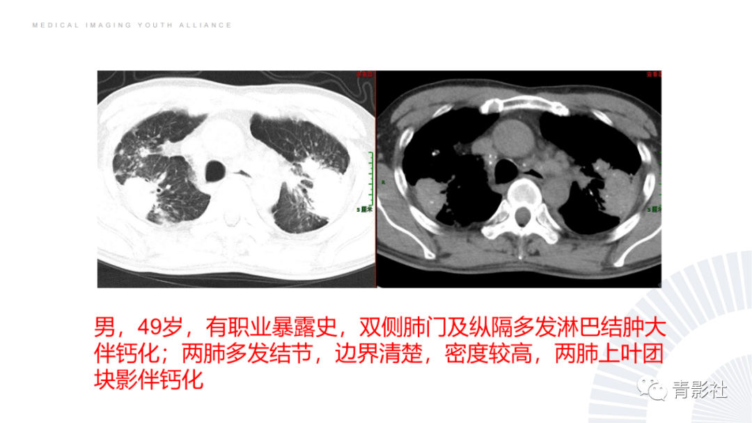 影像PPT - 【PPT】结节病的影像诊断思路-49