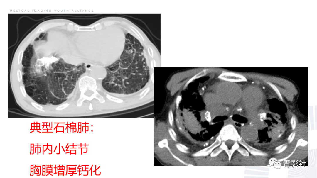 影像PPT - 【PPT】结节病的影像诊断思路-50