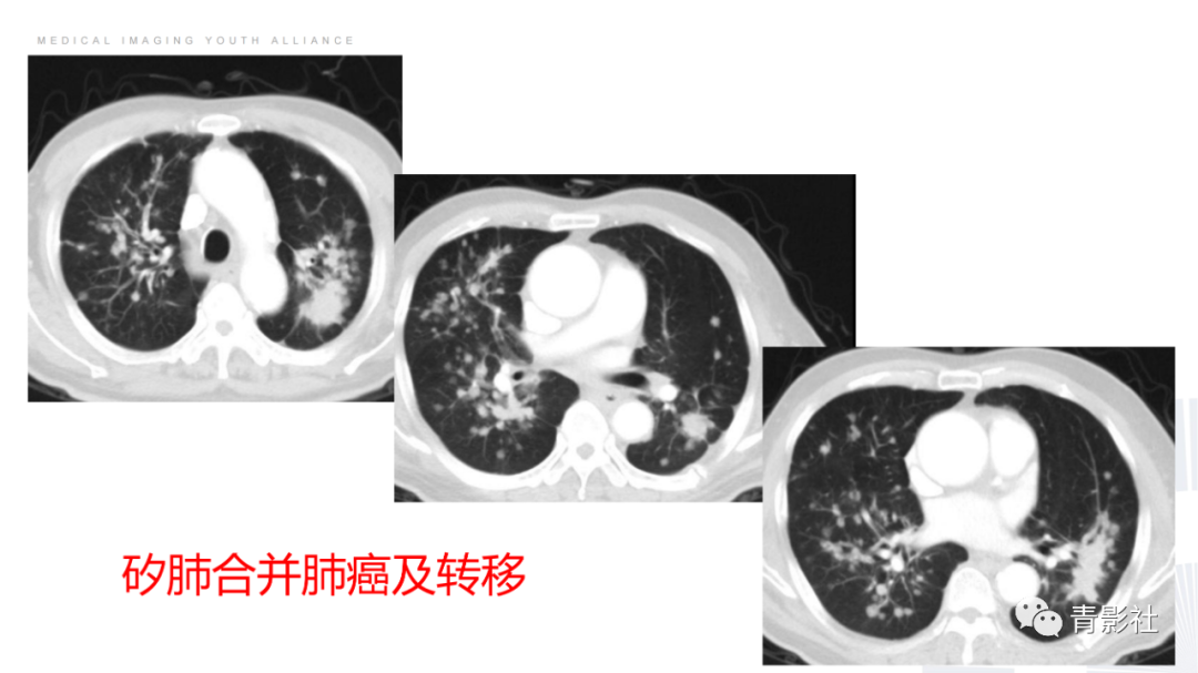 影像PPT - 【PPT】结节病的影像诊断思路-51