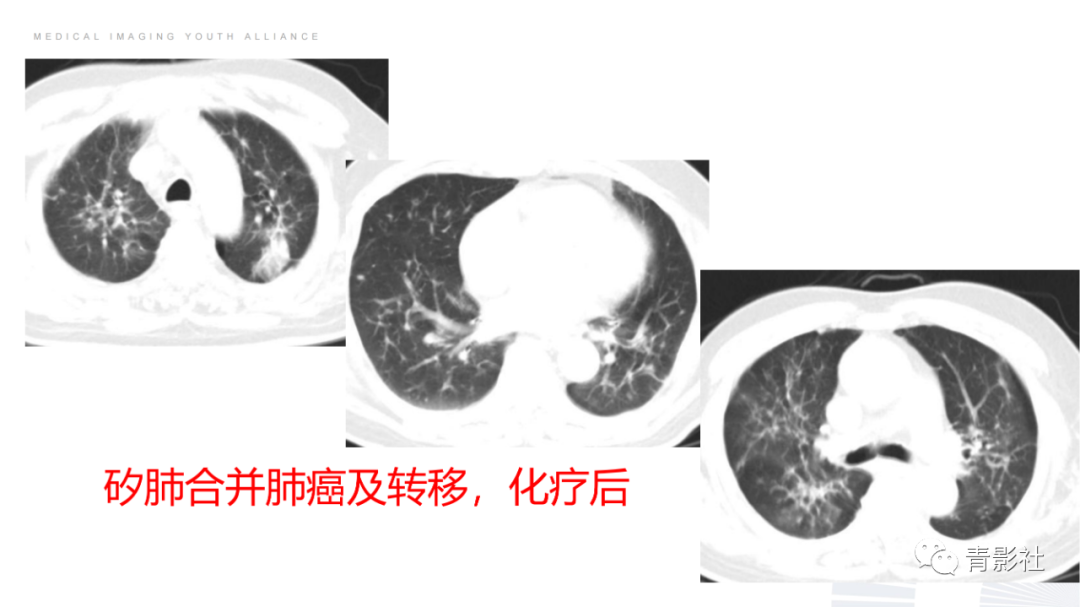 影像PPT - 【PPT】结节病的影像诊断思路-52