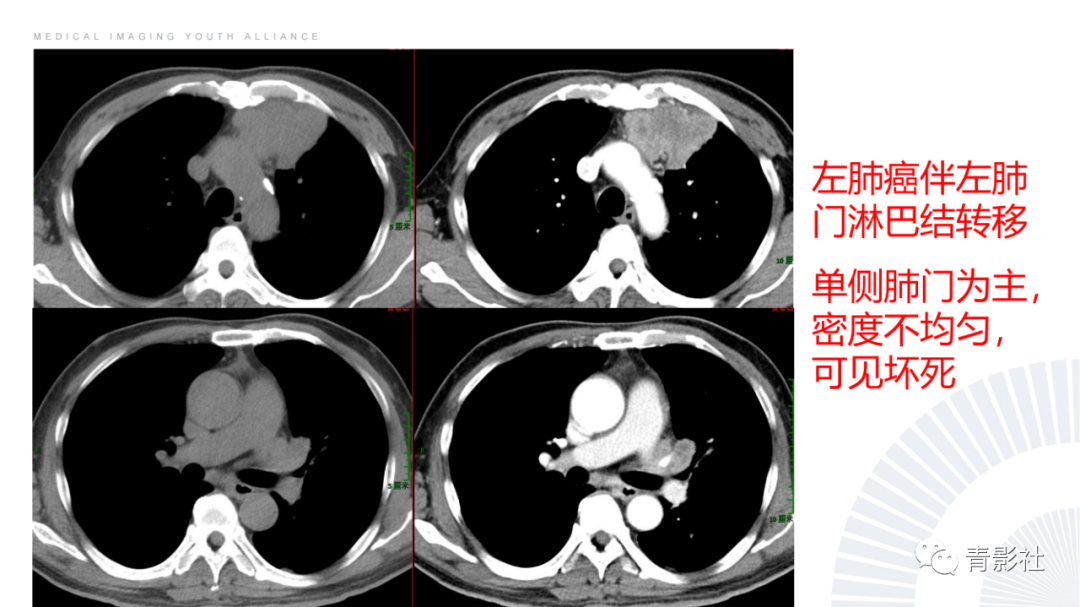 影像PPT - 【PPT】结节病的影像诊断思路-53
