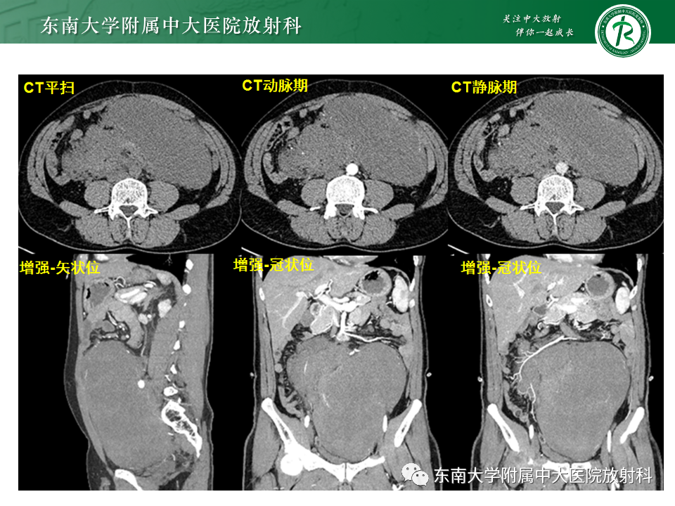 影像PPT - 【PPT】肠系膜区占位病例随访-2
