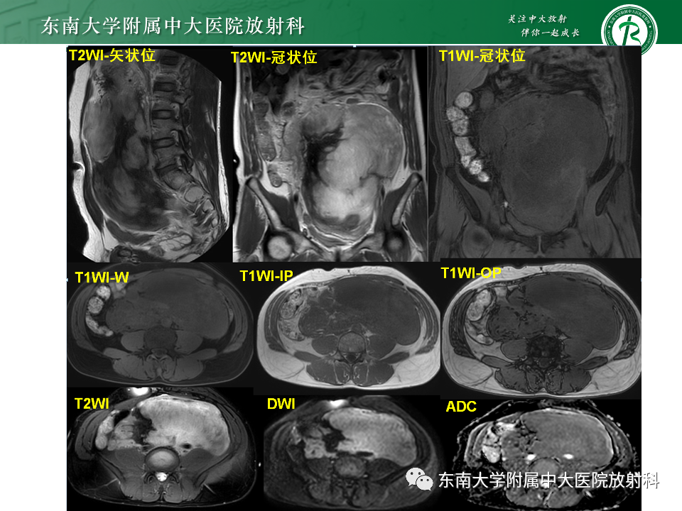 影像PPT - 【PPT】肠系膜区占位病例随访-3