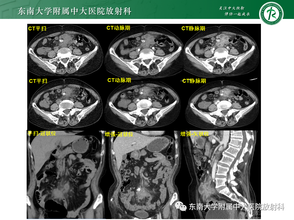 影像PPT - 【PPT】肠系膜区占位病例随访-5