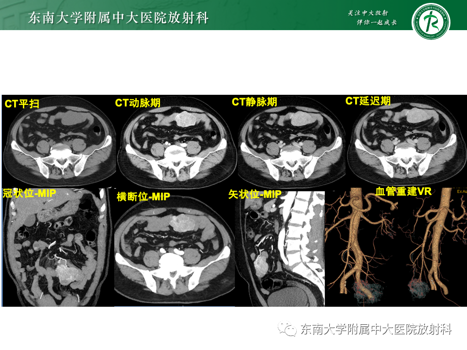 影像PPT - 【PPT】肠系膜区占位病例随访-9