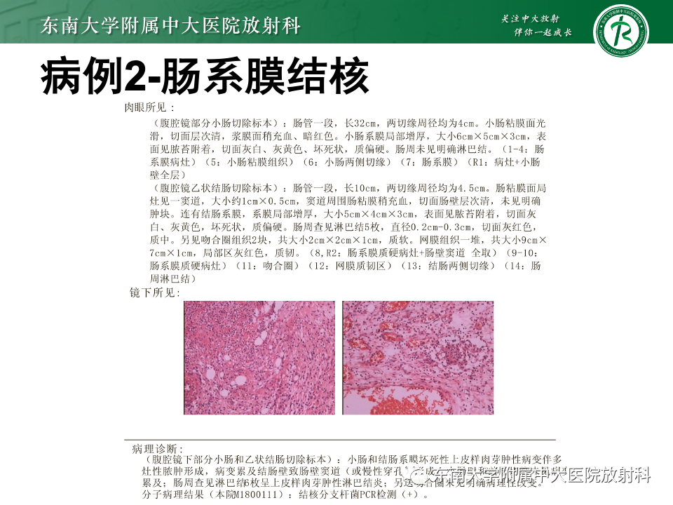 影像PPT - 【PPT】肠系膜区占位病例随访-11