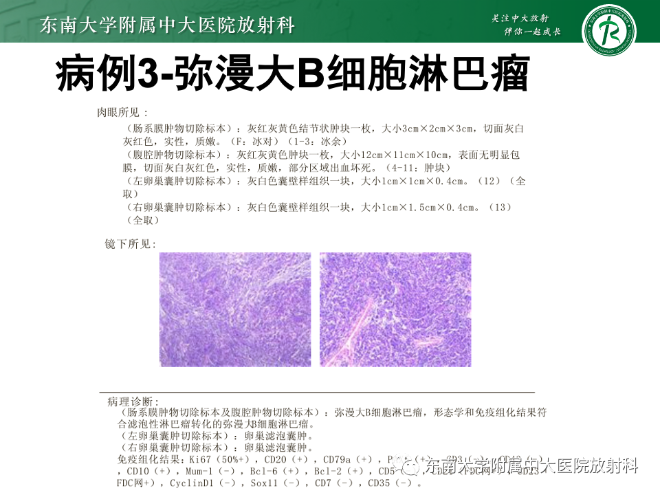 影像PPT - 【PPT】肠系膜区占位病例随访-12