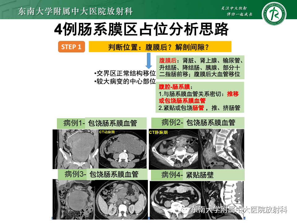 影像PPT - 【PPT】肠系膜区占位病例随访-24
