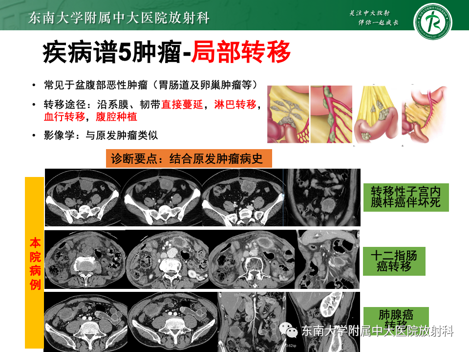 影像PPT - 【PPT】肠系膜区占位病例随访-36