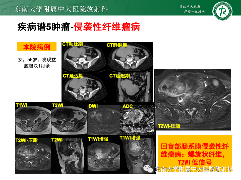影像PPT - 【PPT】肠系膜区占位病例随访-43