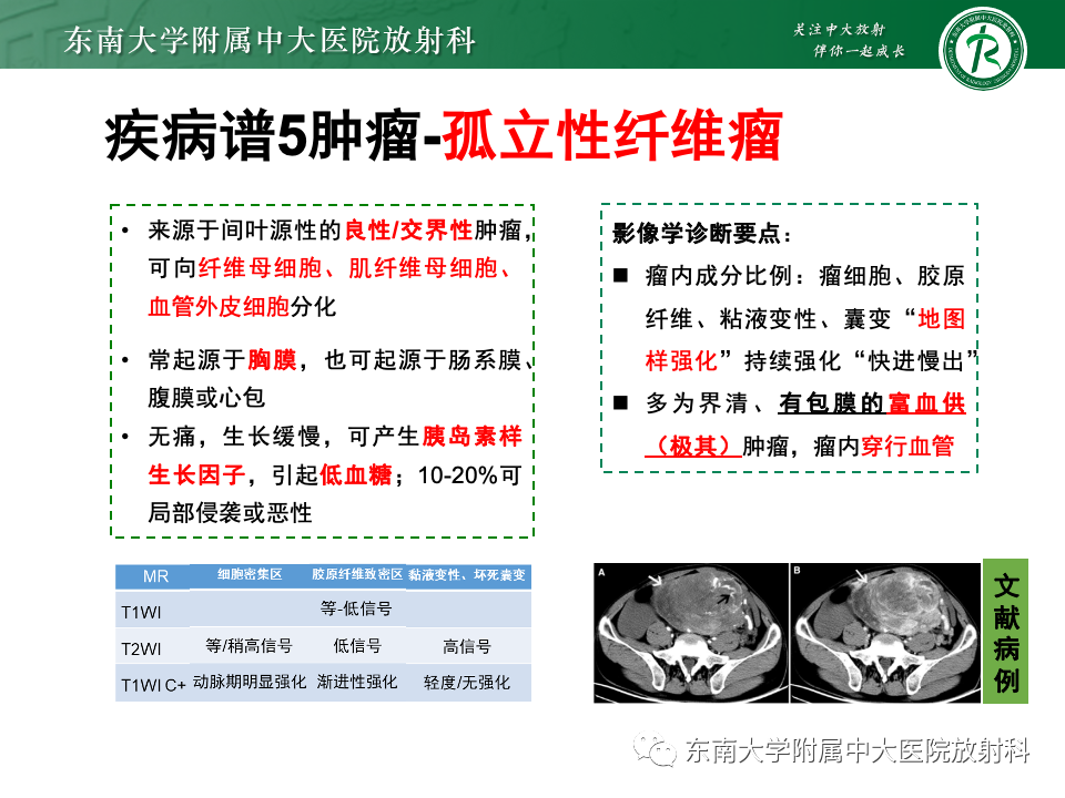 影像PPT - 【PPT】肠系膜区占位病例随访-44
