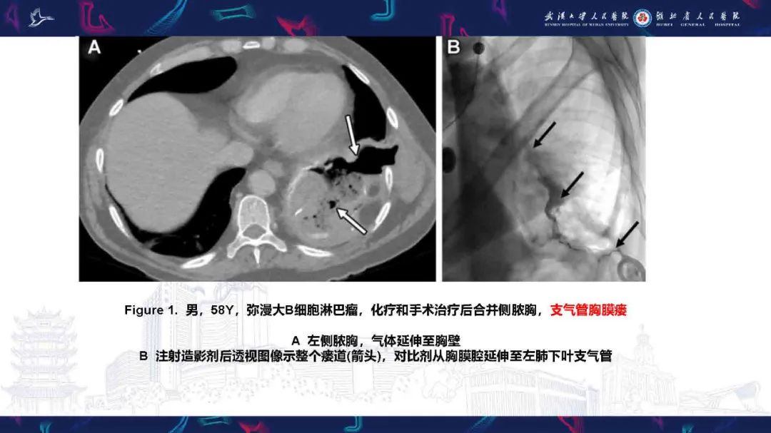 影像PPT - 【PPT】胸膜瘘影像诊断-7