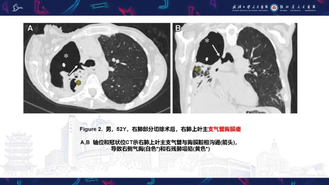 影像PPT - 【PPT】胸膜瘘影像诊断-8