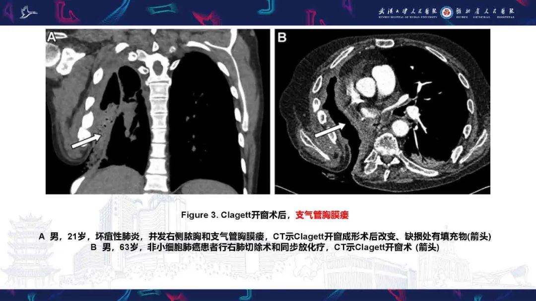 影像PPT - 【PPT】胸膜瘘影像诊断-10