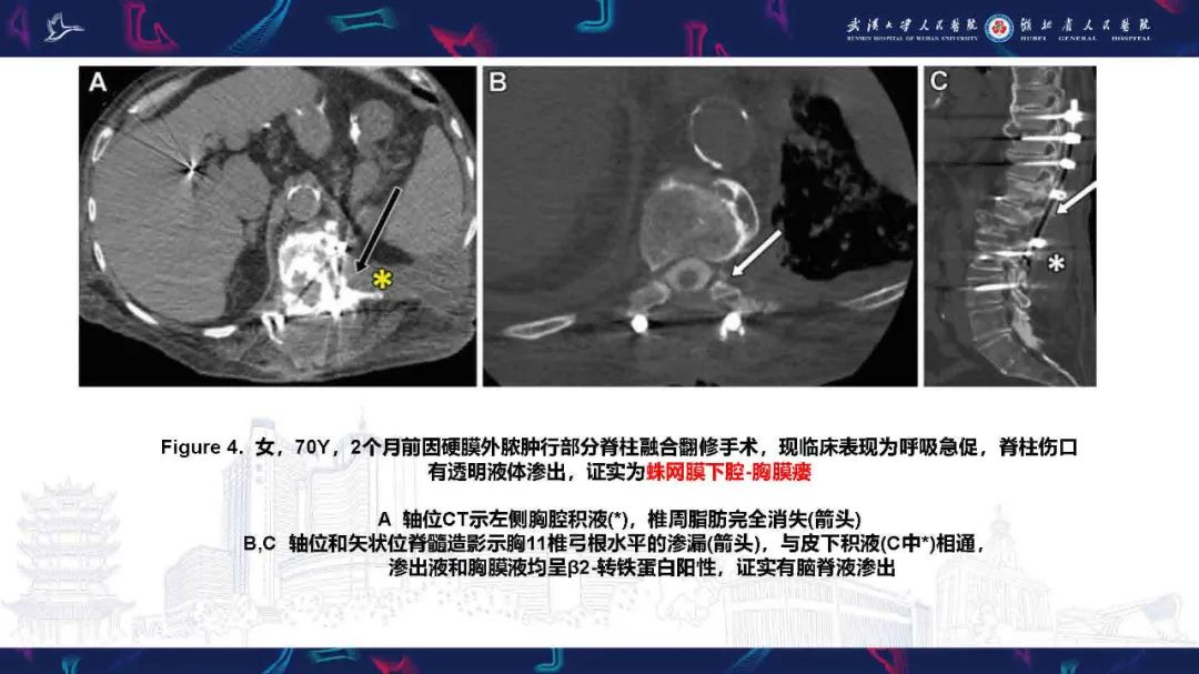 影像PPT - 【PPT】胸膜瘘影像诊断-13