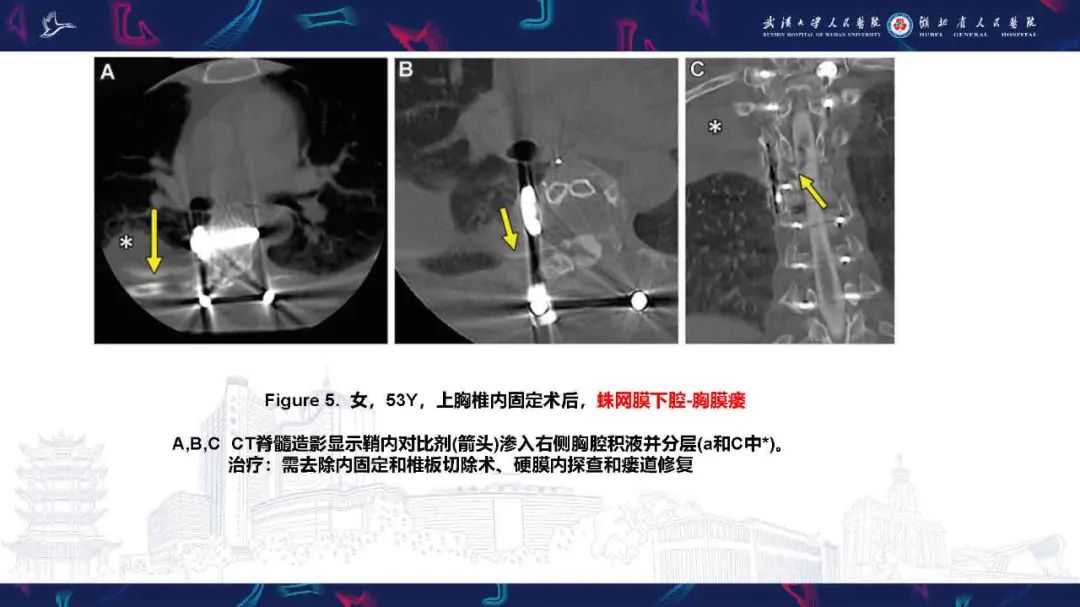 影像PPT - 【PPT】胸膜瘘影像诊断-14