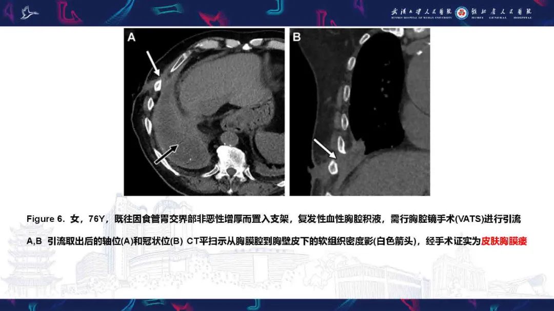 影像PPT - 【PPT】胸膜瘘影像诊断-17