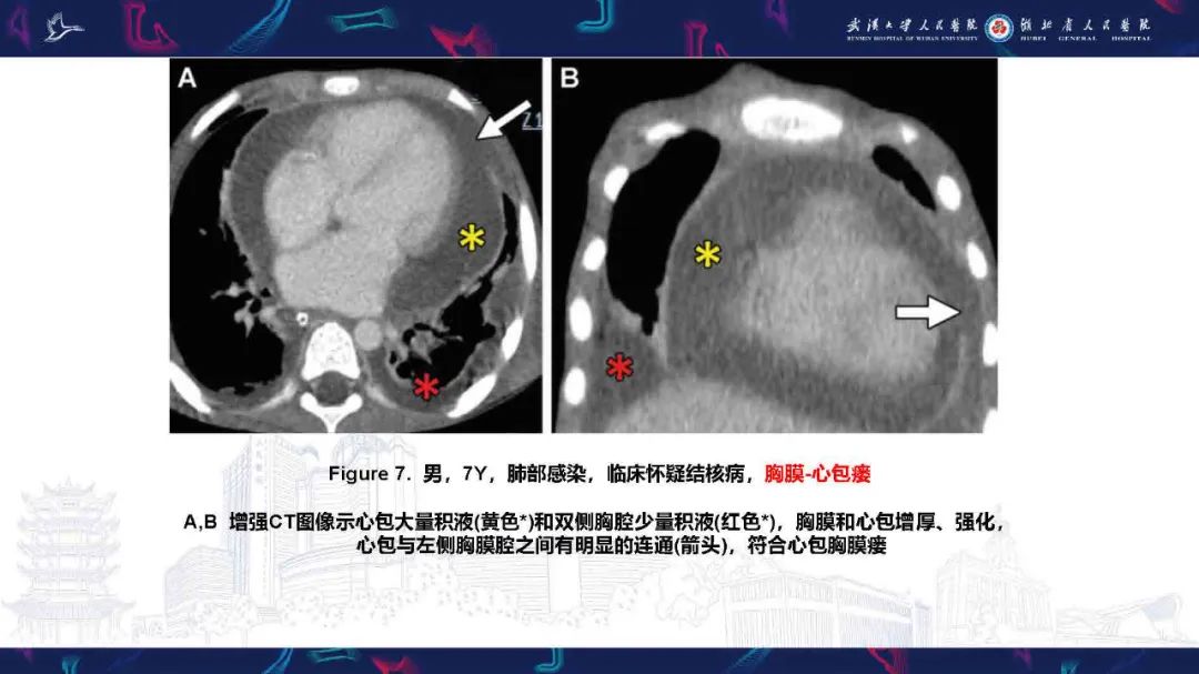 影像PPT - 【PPT】胸膜瘘影像诊断-19
