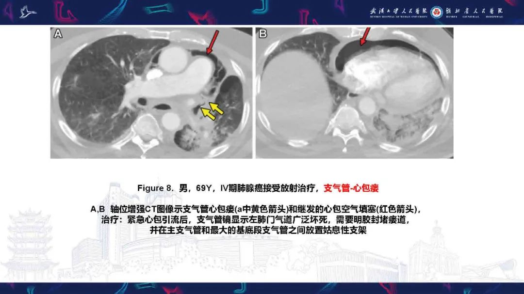 影像PPT - 【PPT】胸膜瘘影像诊断-20