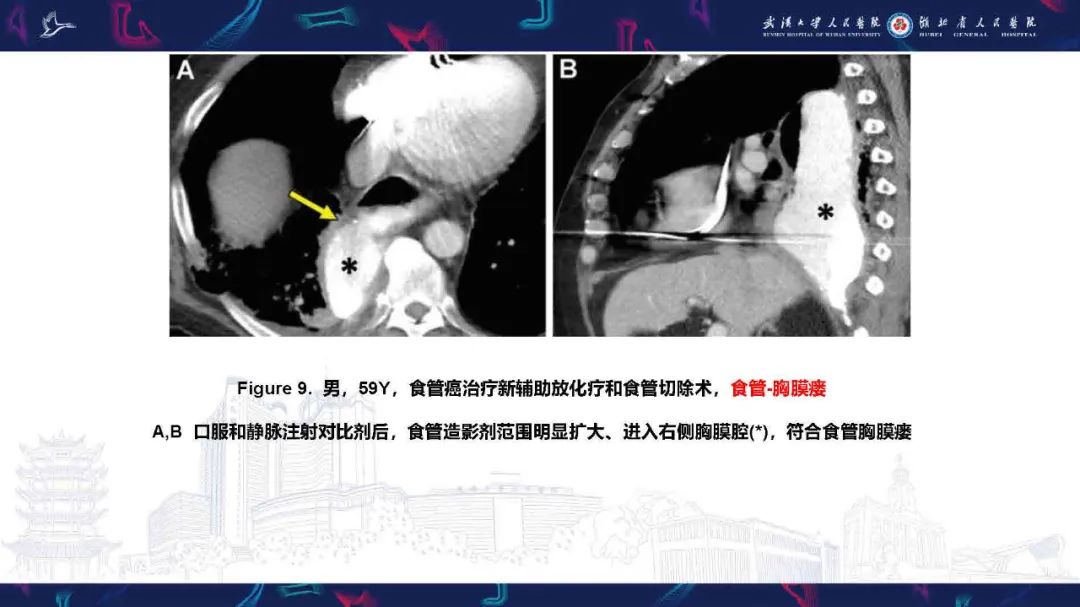 影像PPT - 【PPT】胸膜瘘影像诊断-22